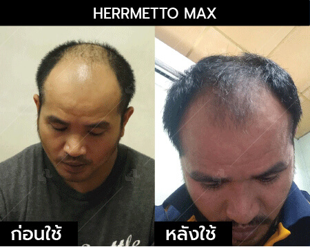รีวิว herrmetto max15